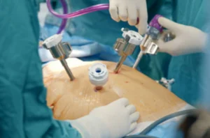 Experienced surgeons performing Laparoscopic surgery on a patient in an operating room