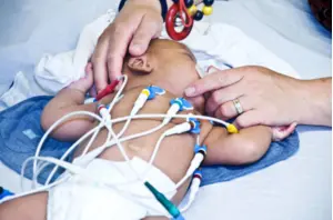 A baby in a hospital bed with wires attached, undergoing pediatric surgery.